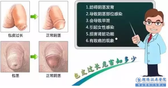 马鞍山包皮过长会导致你不能性生活,你信吗？