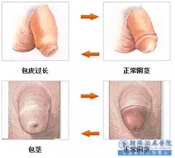马鞍山包皮大概多少钱？为什么不能便宜