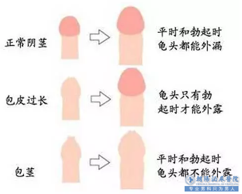 马鞍山包皮过长影响同房吗？包皮过长怎么办？