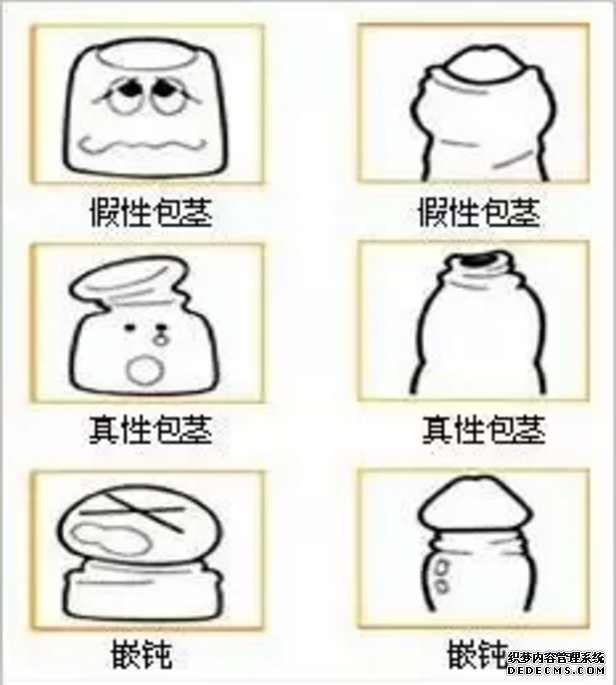 马鞍山教你如何识别包茎?想割包茎多少钱?